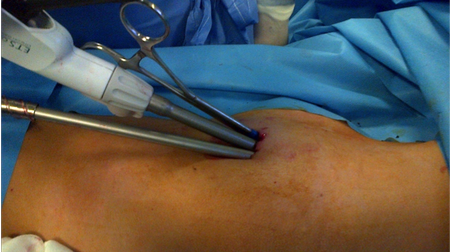 Chirurgia toracica mininvasiva (e UNIPORTALE)